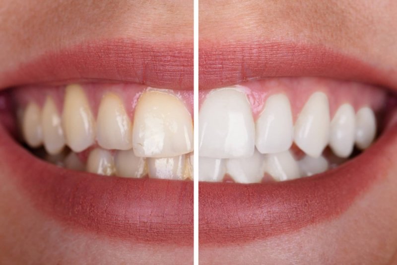 Smiling Teeth Whitening Patient in Midtown East, NYC