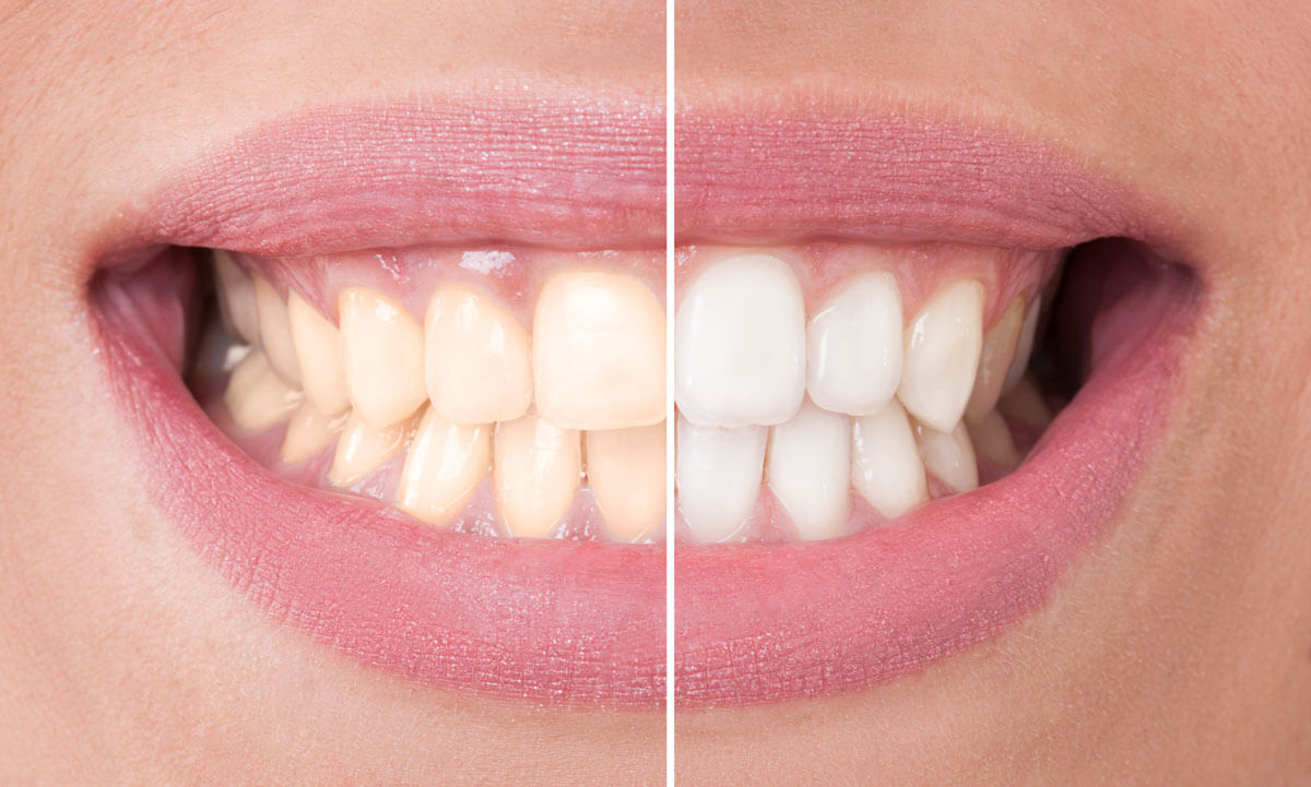 Whitening before and after